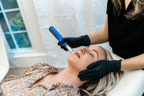 Professional microneedling treatment on a client's upper lip area. A technician wearing black gloves uses a precision electric skin pen to create controlled micro-channels on the skin